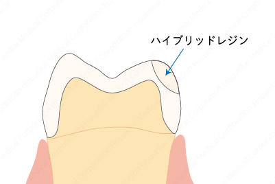 crown-a-02