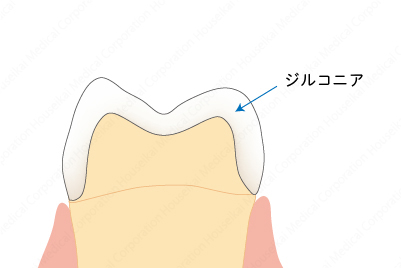 crown-a-03