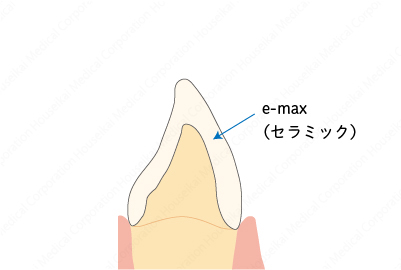 crown-b-04